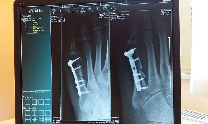 Pedestrian Accident Bone Fractures And The Impact on Victims