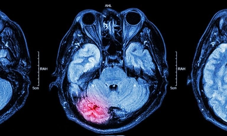 Manhattan TBI Lawyer: What is the Lifetime Cost of Traumatic Brain Injury?